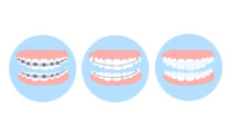 An illustration of teeth during the stages of wearing braces